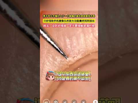 男子手上不慎扎入了一個玻璃纖維光有痛感就是找不到，只好藉助手機攝像頭的放大功能，最終找到拔出，網友：沒防護措施一定不要接觸玻璃纖維！#shorts thumbnail