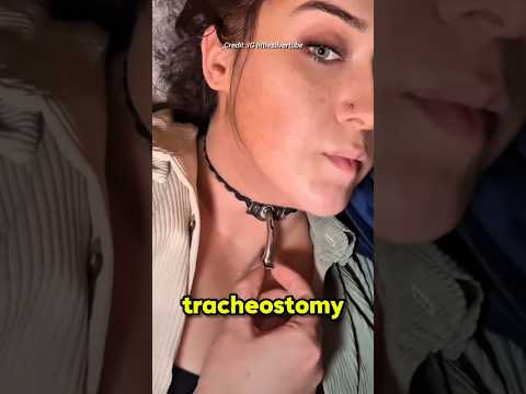 Tracheostomy Device Explained thumbnail