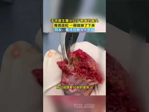 手術醫生展示52歲患者的骨頭，骨質疏鬆 一掰就掉了下來，網友：看得我骨頭不舒服！ ！ #大熱門 #china thumbnail