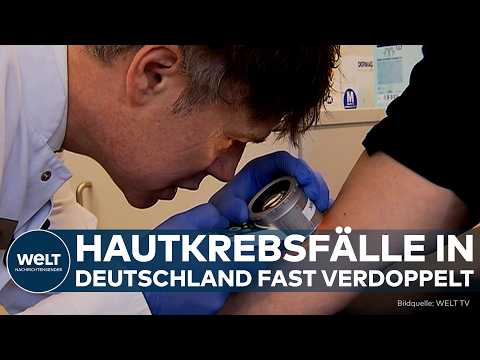 DEUTSCHLAND HAUTKREBSFÄLLE: Immer mehr Diagnosen – trotzdem steigen die Todeszahlen drastisch thumbnail