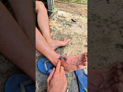 luka ngokngok belum kering kering thumbnail
