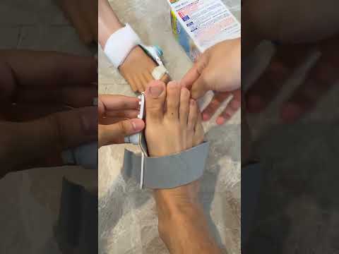 How to Correct Toe Deformity at Home ( # 2115 ) ▶️ Adjustable Foot Care Big Toe Straightener thumbnail