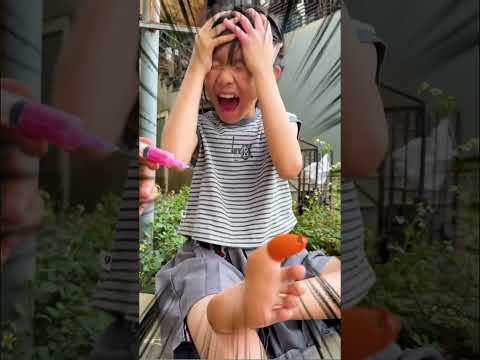 CCT - Điều trị ngón chân đau || Treatment for painful toes. thumbnail