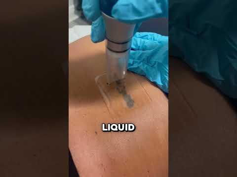 How This Patch Makes Laser Tattoo Removal 10x Faster 🤯 thumbnail