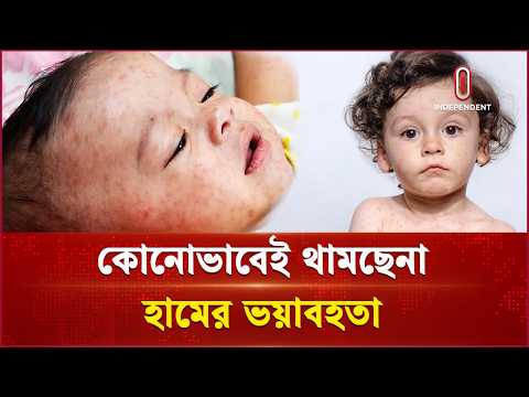 হাসপাতালে বাড়ছে হামে আক্রান্তের সংখ্যা | Country Measles | Independent TV thumbnail