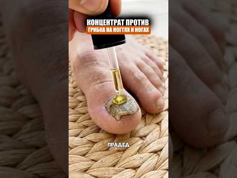 Масло от грибка на ногах thumbnail