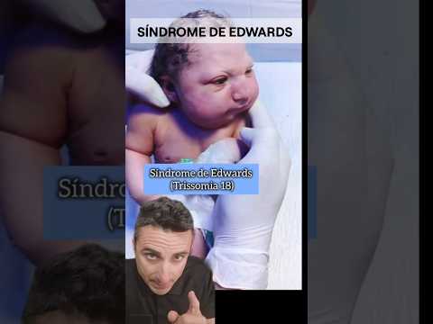 Sindrome de Edwards. #supervivencia #curiosidades #sabiasque thumbnail