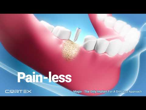 Cortex Dental Implants.  The Future of Dental Implants. thumbnail