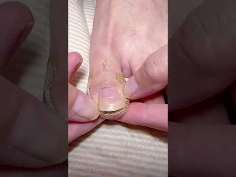 ▶️ Relief starts here Toe Align Ingrown Nail Corrector Stickers ( # 2609 ) thumbnail