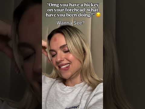Shocking Forehead Hickey Has Everyone Asking The Same Question thumbnail