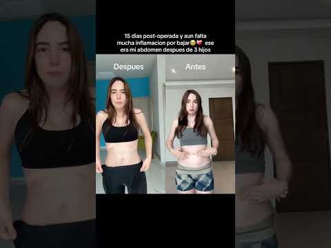 El mago fue @GC cirugiaplasticamonterrey #lipo #miniabdominoplastia #Viral #tuneada #vidademamá thumbnail
