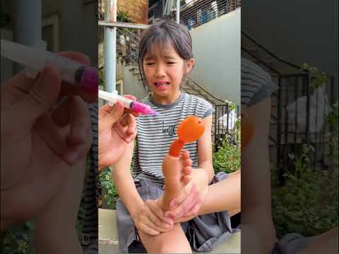 CCT - Điều trị ngón chân đau || Treatment for painful toes. thumbnail