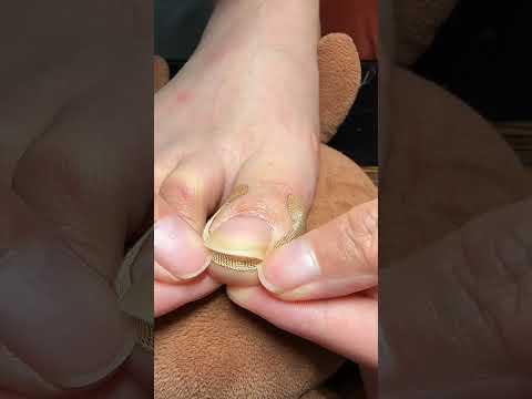 ✅ Relief starts here. Toe Align Ingrown Nail Corrector Stickers ( # 2609 ) thumbnail