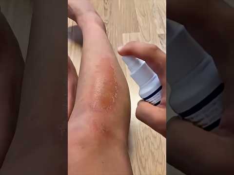 Quand tu desinfectes une blessure 🚑 thumbnail