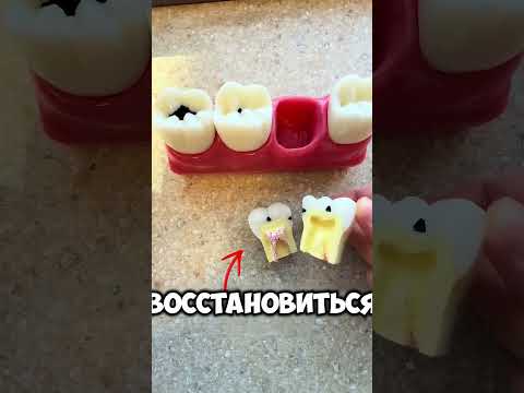 Почему нельзя игнорировать кариес! thumbnail