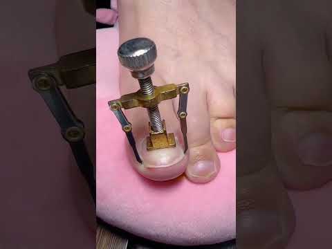 Toe Nail Support Pad ( # 2620  ) 1️⃣Product Link in Bio thumbnail