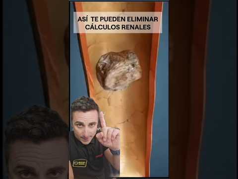 Así te pueden eliminar cálculos renales.#supervivencia #curiosidades #sabiasque thumbnail