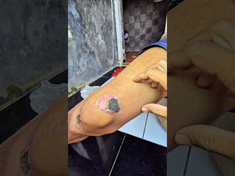 luka di lutut ngokngok gede banget?? thumbnail