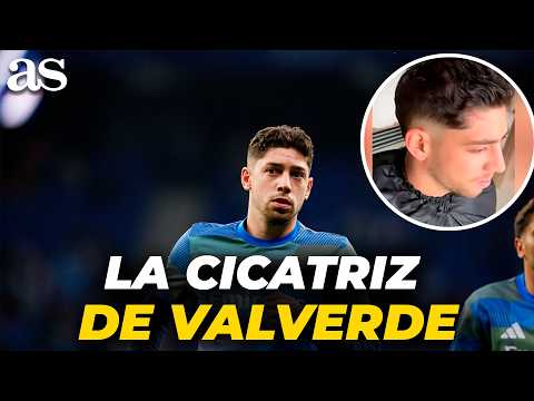 La primera imagen de la cicatriz de Valverde tras la pelea con Tchouameni: impresiona thumbnail