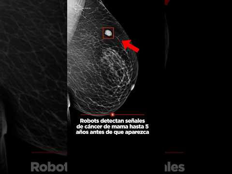 Robots detectan señales de cáncer de mama hasta 5 años antes de que aparezca thumbnail