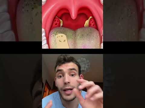 Tonsilolitos #datoscurisos #sabiasque #boca thumbnail