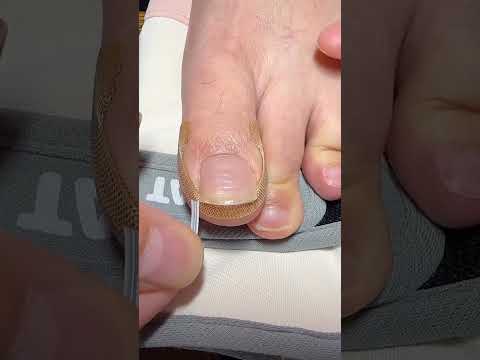 Say Goodbye to Ingrown Toenails with These Simple Stickers( # 2609  ) 1️⃣ thumbnail
