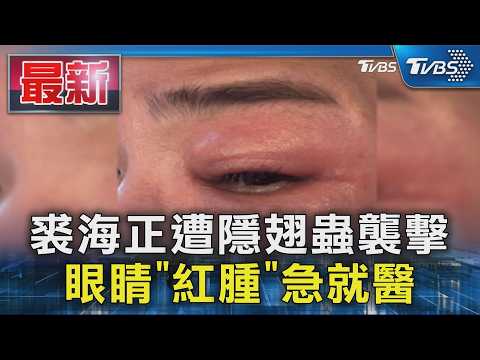 裘海正遭隱翅蟲襲擊 眼睛「紅腫」急就醫｜TVBS新聞 @TVBSNEWS01 thumbnail