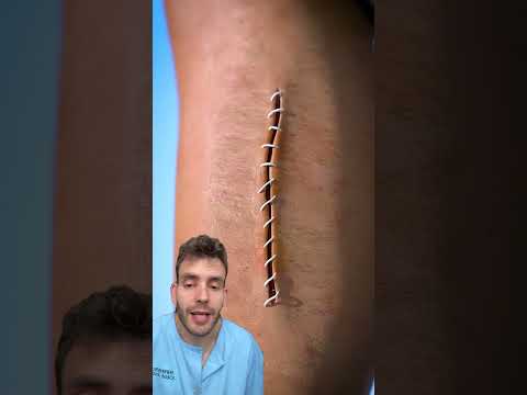 Tipos de cicatrización por intención #datoscurisos #sabiasque #medicina thumbnail