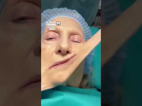 Surgeon stretches my face around 😅 thumbnail