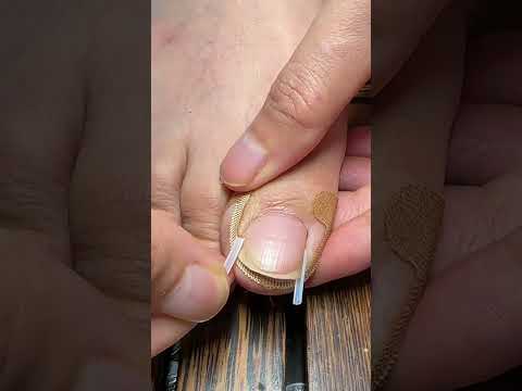 ✅ Effective toenail care for foot pain ( # 2553 ) - Toe Nail Support Pad thumbnail