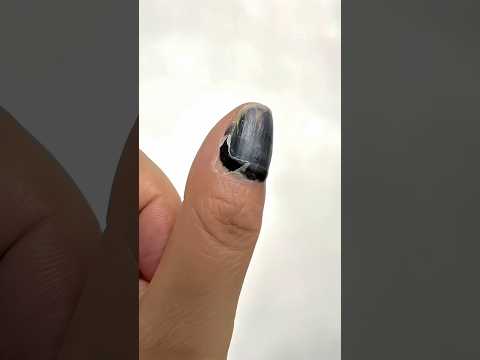 Proses Penyembuhan Kuku Karena Terpukul Palu thumbnail