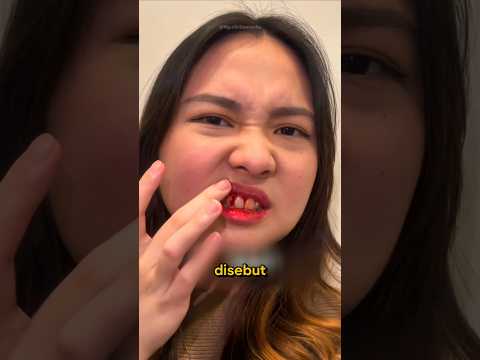 Cara Mudah Atasi Gusi Berdarah thumbnail