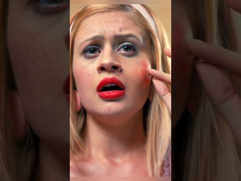 Nikt nie spodziewał się tego, co wyszło z pryszcza… 😱#shortvideo #viral thumbnail