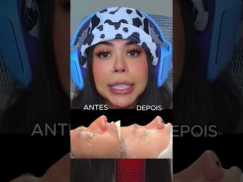 Rafael Fez a Cirurgia no Nariz #shorts thumbnail
