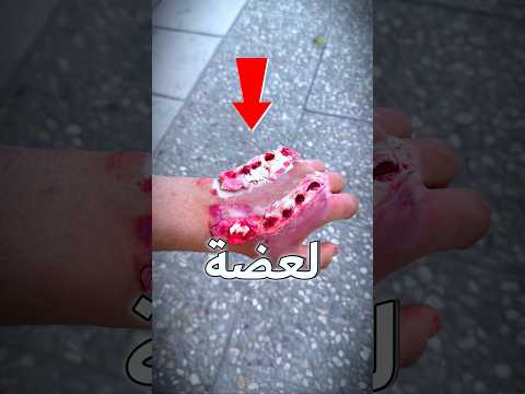رسمت على أيدي ‏عظة كلب ومقلبت دكاترة المستشفى? thumbnail