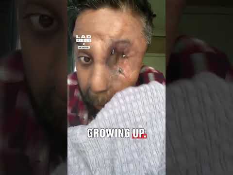 He has to take his eye out to clean it 🤯👁️ #health #beauty #interesting thumbnail