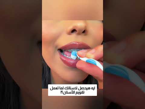ايه هيحصل لاسنانك لما تعمل تقويم الأسنان؟! thumbnail