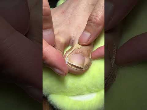 Say Goodbye to Ingrown Toenails with These Simple Stickers( # 2609  ) 1️⃣ thumbnail