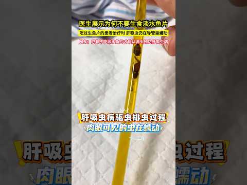 醫生展示為何不要生食淡水魚片，吃過生魚片的患者治療時，肝吸蟲仍在導管裡蠕動，網友：只有不吃淡水魚片才能從源頭預防肝吸蟲病！#shorts thumbnail