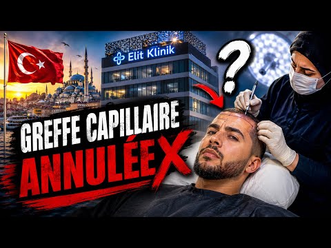 CHOQUÉ ! Ma greffe capillaire à Istanbul… ANNULÉE  thumbnail