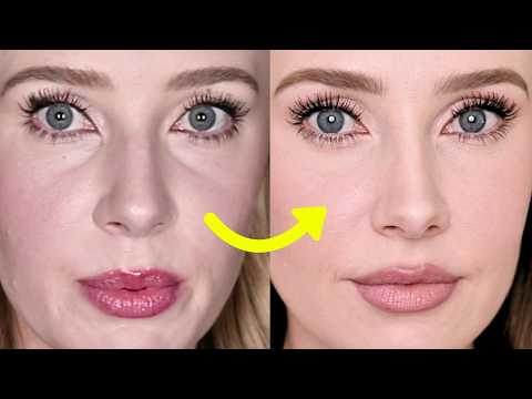 Why I Chose Plastic Surgery Over Filler (And Don’t Regret It) thumbnail
