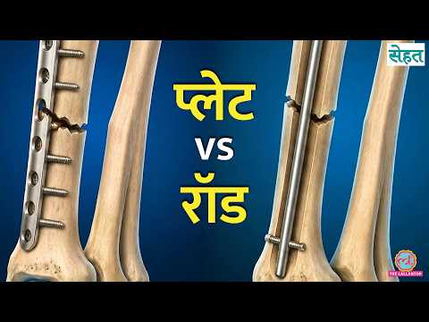 Fracture होने पर Plaster की जगह Plate या Rod कब लगाते हैं, कौन बेहतर? | Sehat Ep 1371 thumbnail