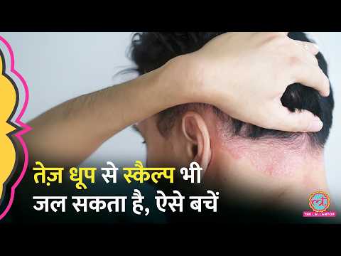 Scalp Sunburn के रिस्क पर सबसे ज़्यादा ये लोग, ऐसे लक्षण दिखें हो जाएं सावधान thumbnail