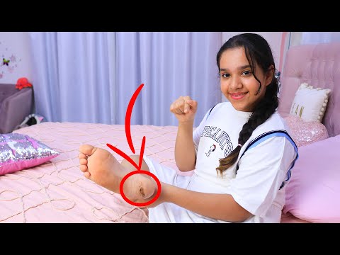 أخير طلعت الجبيرة و صرت أمشي ! thumbnail