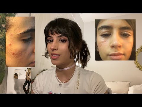 حبوب الشباب thumbnail