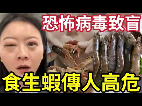 港人小心！變種蝦病毒「可以人傳人」嚴重上眼致盲！生醃海產「引蟲入身」潛伏期10年！三大招數「如何避險！」 thumbnail