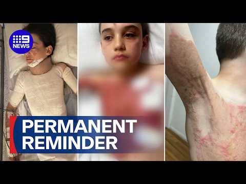 Young boy lucky to be alive wants people more vigilant this Burns Awareness month | 9 News Australia thumbnail