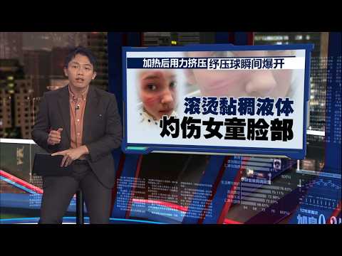 女童脸上炸出长伤痕恐永久留疤   女童母亲: 幸好没喷进女儿眼睛 | 新闻报报看 24/05/2026 thumbnail