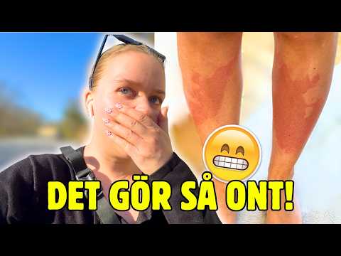 BLEV BRÄNNSKADAD 😭| Vlogg thumbnail