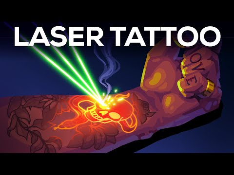 Tattoo Removal Is Insane thumbnail